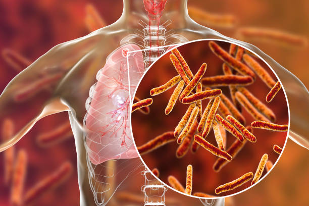 Tuberculosis is basically an infection caused by bacteria, its prime target is lungs.