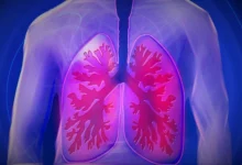 Respiratory diseases are the diseases related to lungs and airways which directly affect respiration.