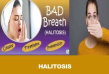 Halitosis is a term used for bad breath or oral malodor.