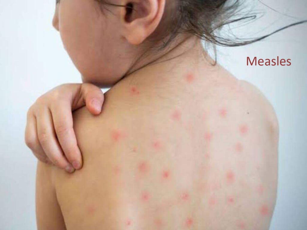 Measles threat is also taken very seriously because it is a very serious rather deadly air borne disease which is primarily cause due to a virus.